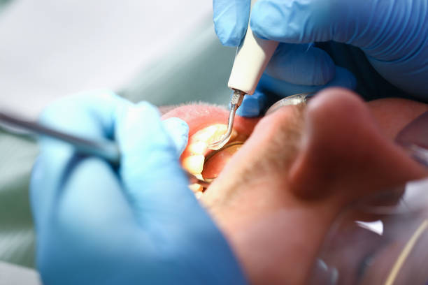 Best Knocked-Out Tooth (Avulsed Tooth) Treatment in Oakdale, CA