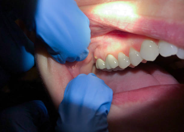 Best Emergency Wisdom Tooth Extraction in Oakdale, CA