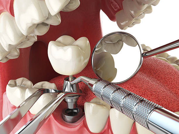 Best Emergency Wisdom Tooth Extraction in Oakdale, CA